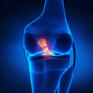 acl tear treatment dallas and frisco