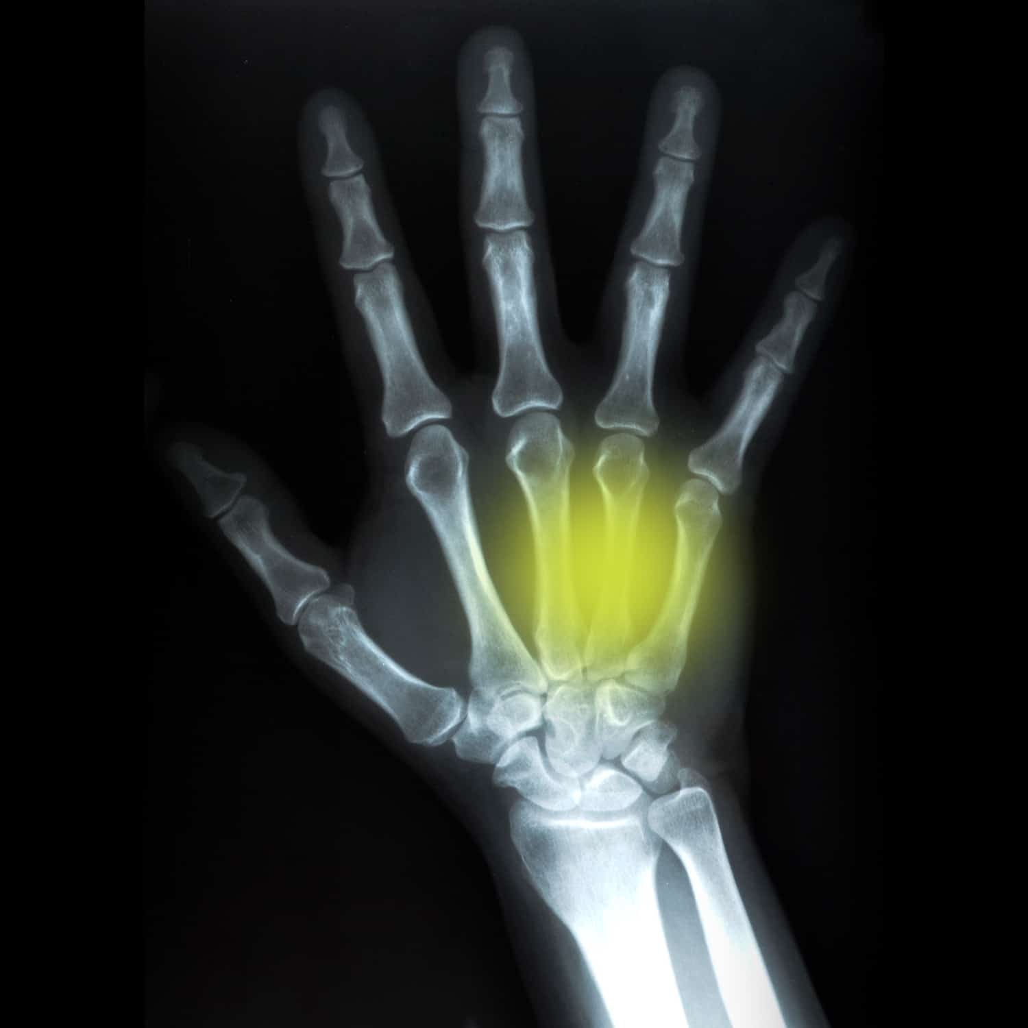 boxer-fracture-treatment-in-dallas-boxers-fracture-surgery