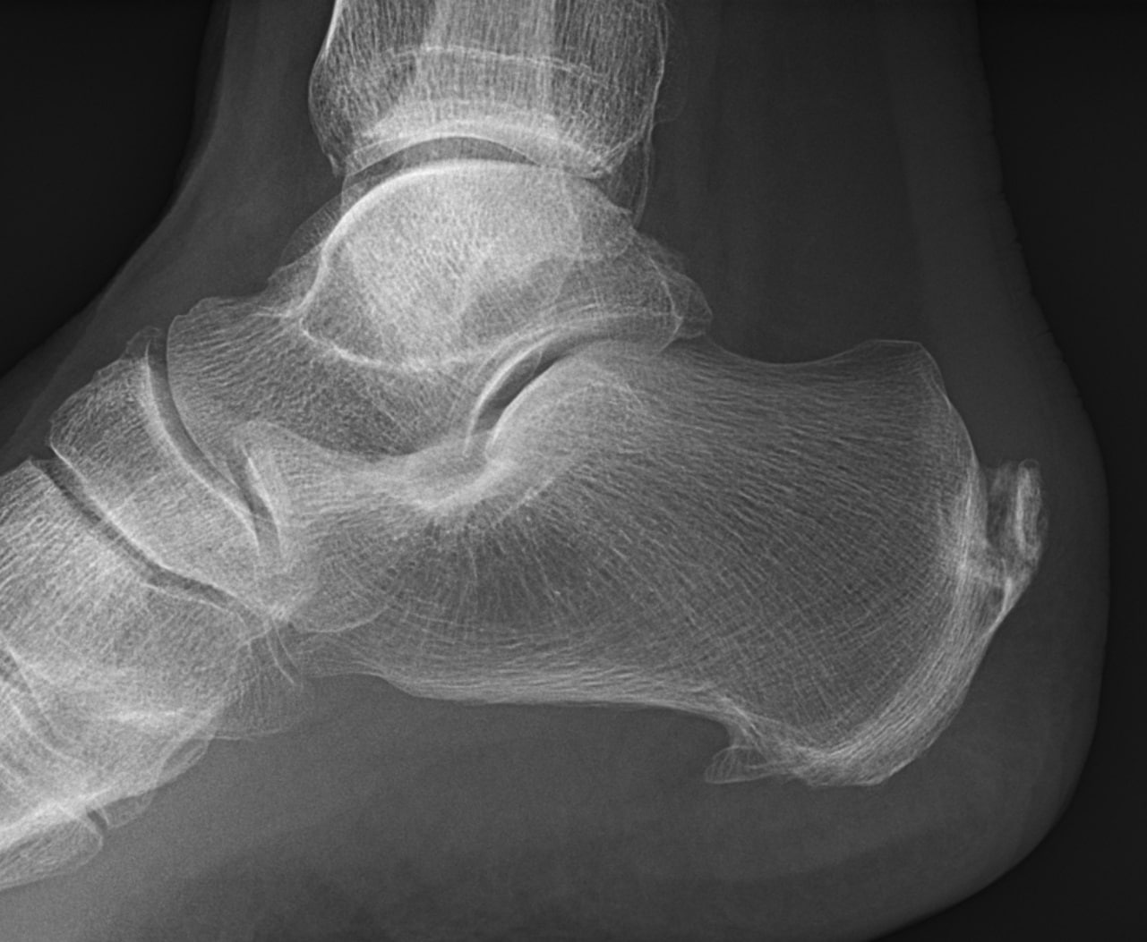 heel-spur-surgery-sport-orthopedics-dallas-frisco-tx