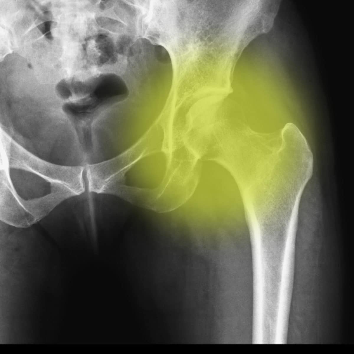 hip replacement surgeon in dallas