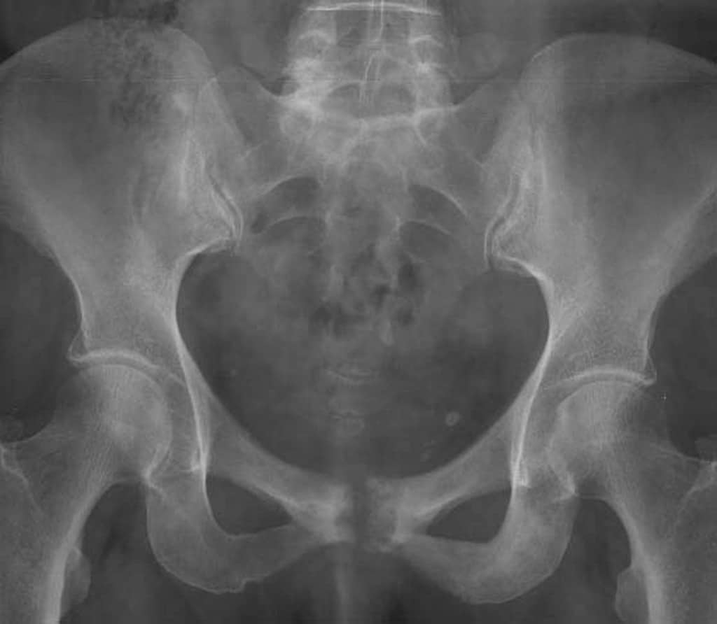 Pubic Bone Pain, Osteitis Pubis, Pelvic Bone Pain