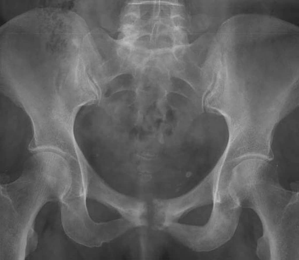 Symphysis Pubis Dysfunction - Pubic Bone Pain