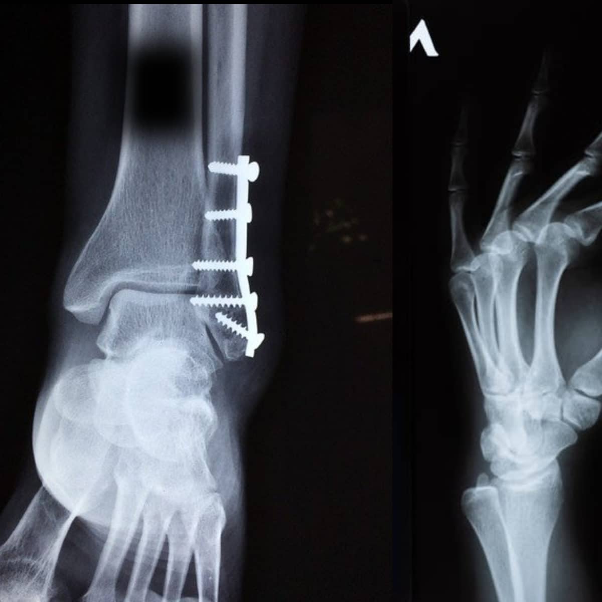 fracture surgery