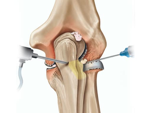 elbow arthroscopy