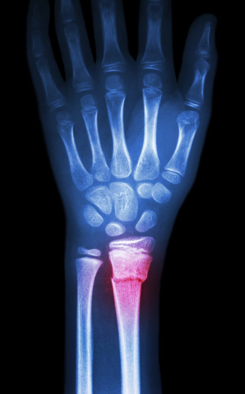 Colles Fracture Reduction and Plaster Technique 