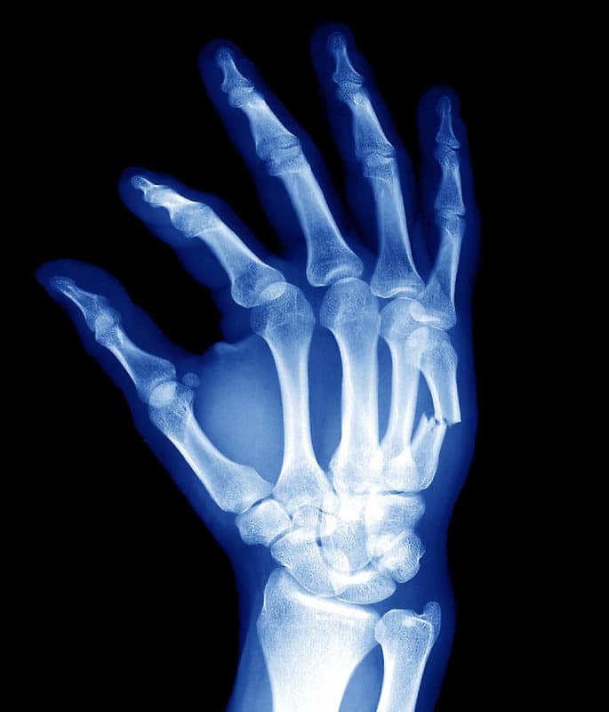 Hand Fracture | SPORT Orthopedics | Dallas & Frisco, TX