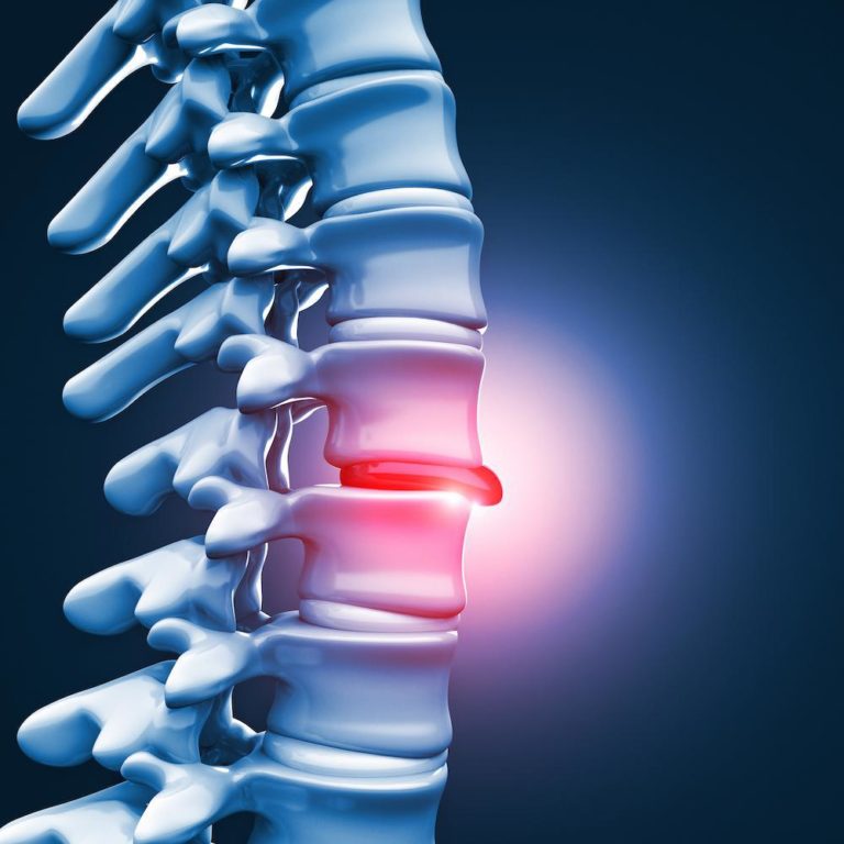 Bulging Disc Treatment Dallas & Frisco Bulging Disc Specialist DFW