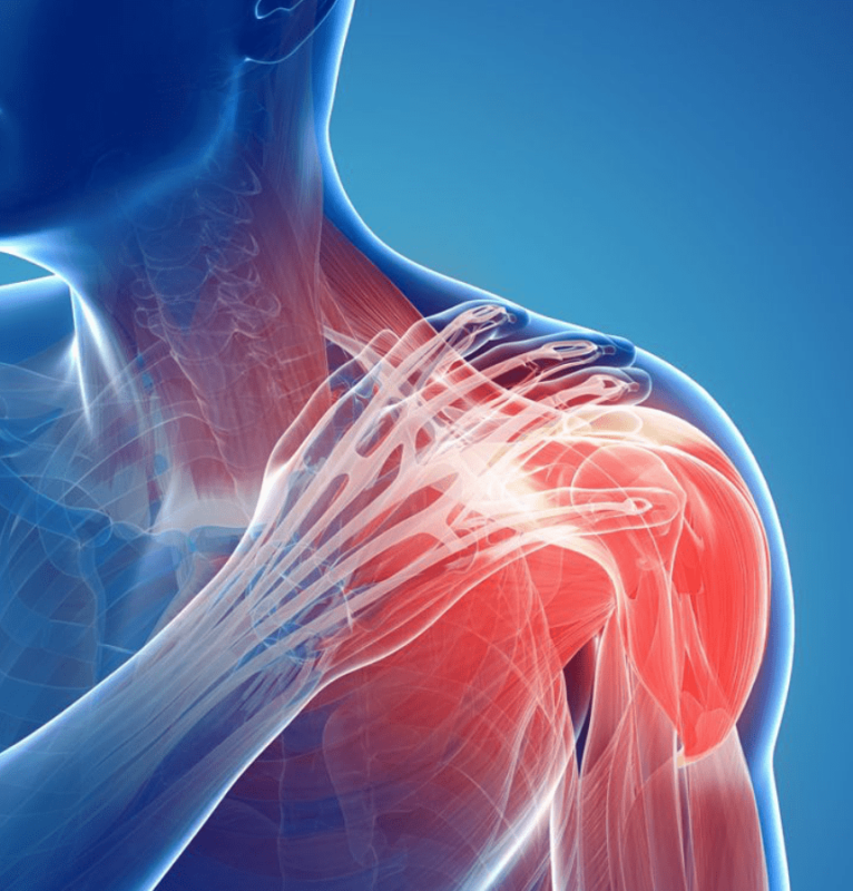 Shoulder Dislocations | SPORT Orthopedics | Dallas & Frisco, TX