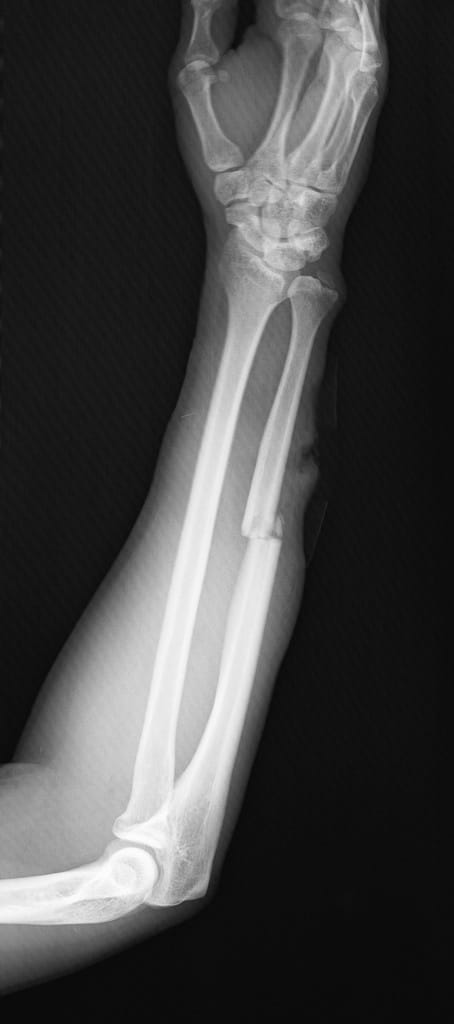 ulna bone