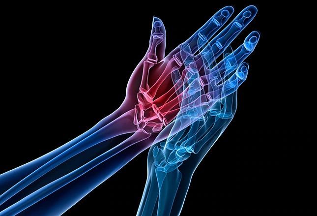 Bump on and Hand | SPORT Orthopedics | Dallas & Frisco, TX