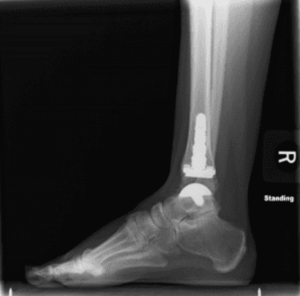 ankle replacement in dallas