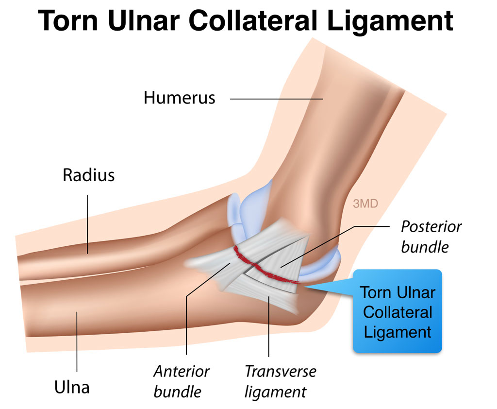 ulnar collateral ligament tear