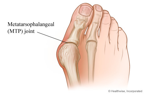 Foot Sprain (Metatarsophalangeal Joint): Exercises