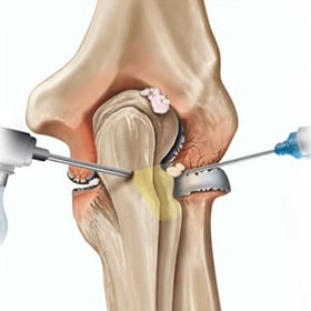 arthroscopic elbow surgery
