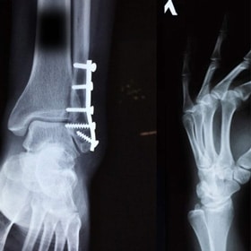 Fracture Surgery