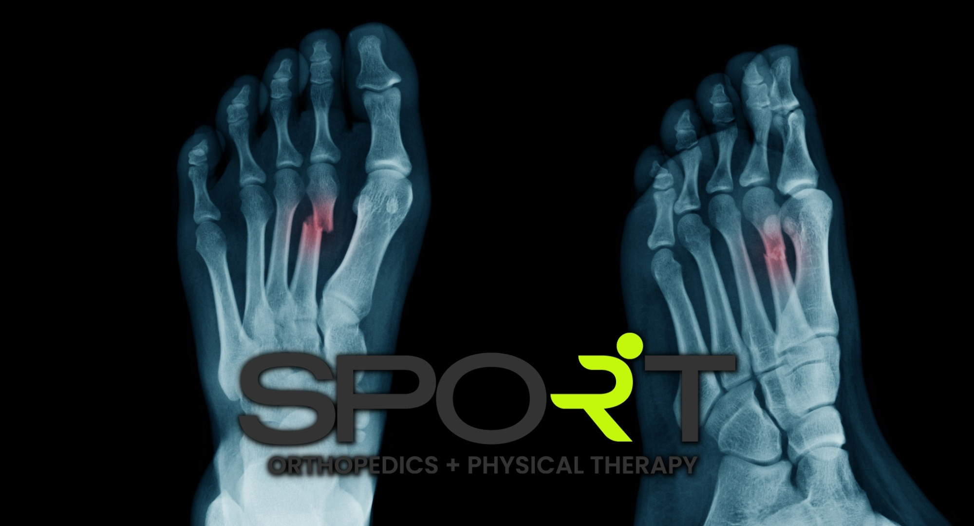 Foot Fracture Treatment Sport Orthopedics And Rehabilitation 0466