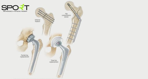 hip fracture surgery