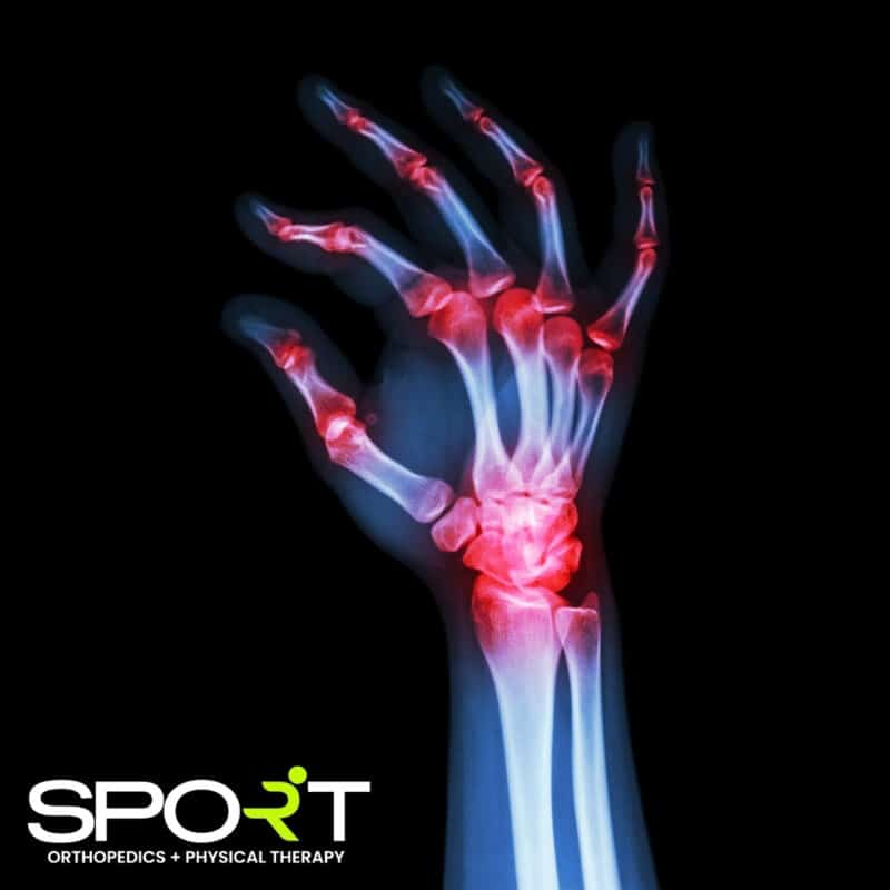 Arthritis Treatment In Dallas And Frisco Sport Orthopedics 2626