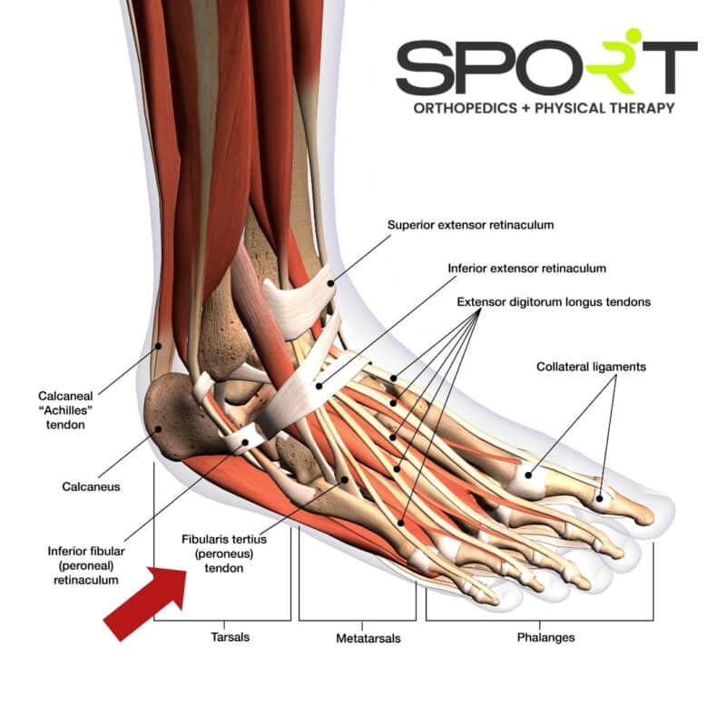 Peroneal Tendonitis Treatment | Dallas & Frisco | Sport Orthopedics