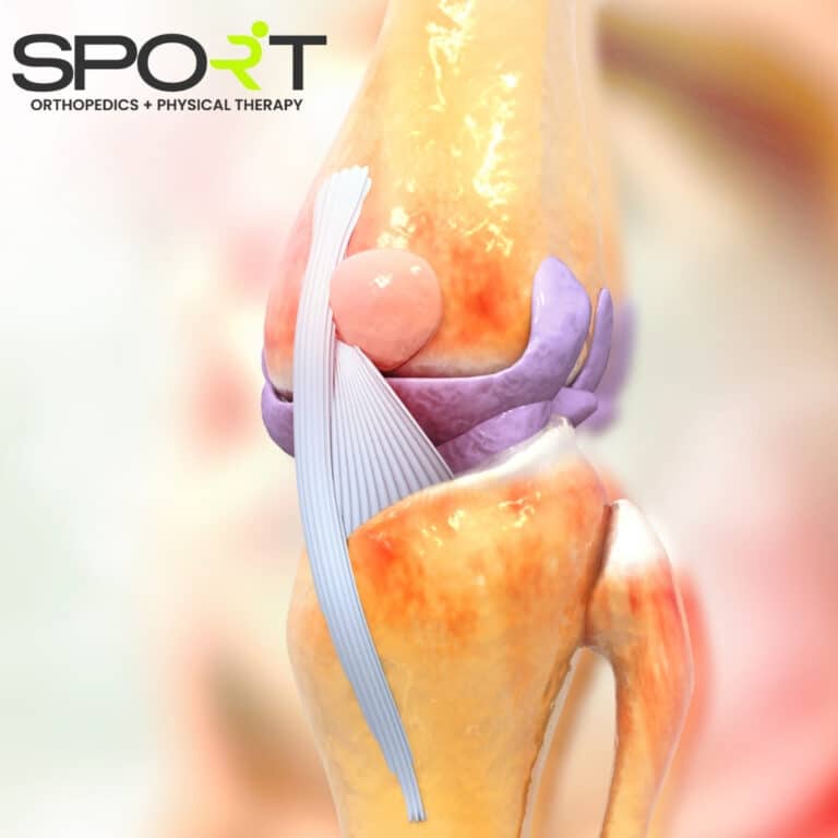 Jumper's Knee SPORT Orthopedics Dallas & Frisco, Texas