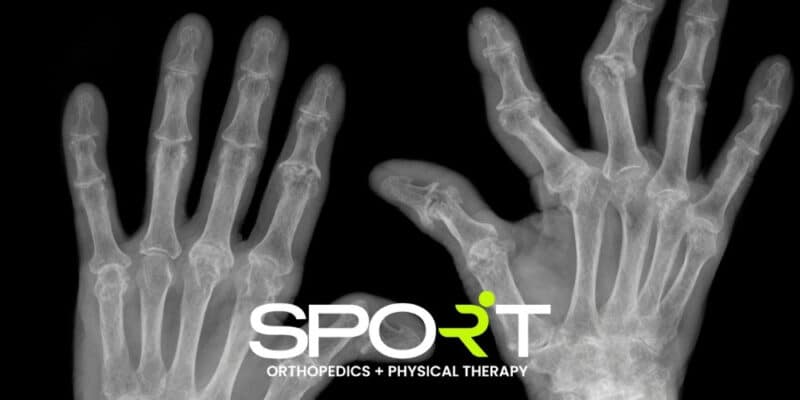 Osteoarthritis vs Rheumatoid Arthritis | SPORT Orthopedics | Dallas