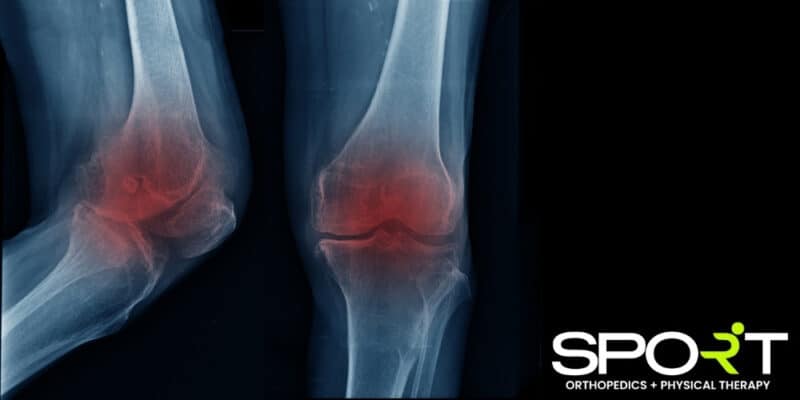 how is knee arthritis diagnosed