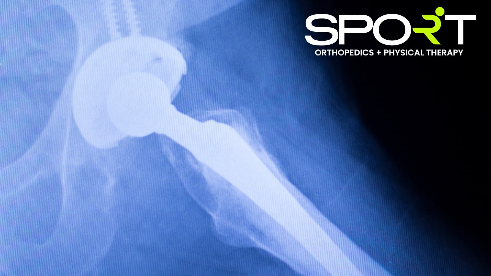 what-not-to-do-after-hip-replacement-surgery-sport-dallas