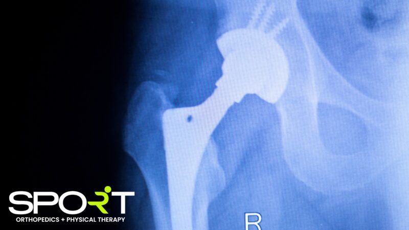 anterior hip replacement surgery