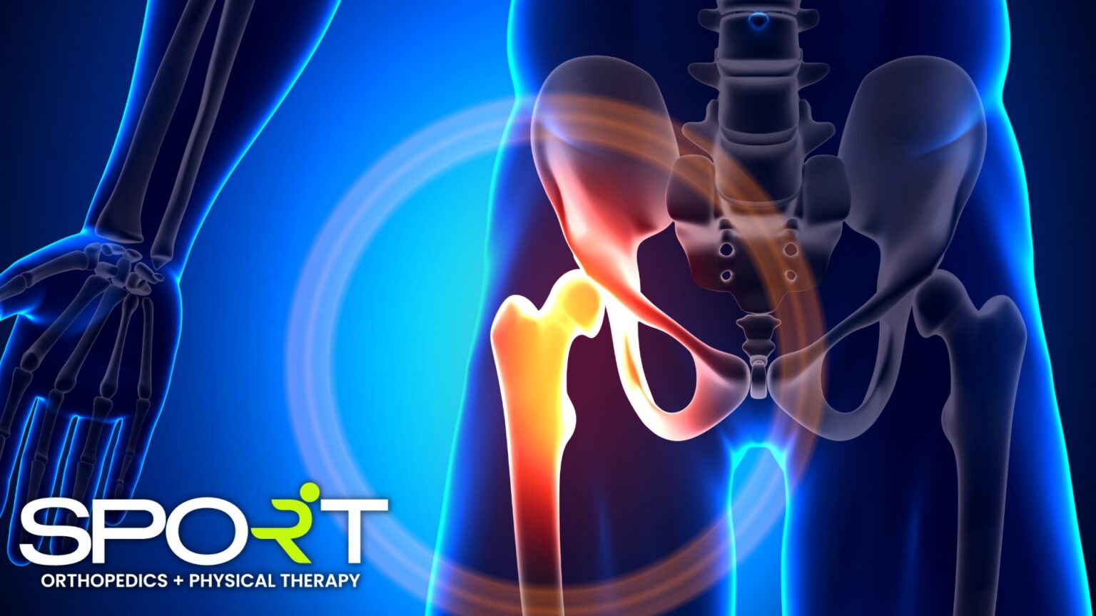 Anterior Hip Replacement SPORT Orthopedics Dallas, Texas