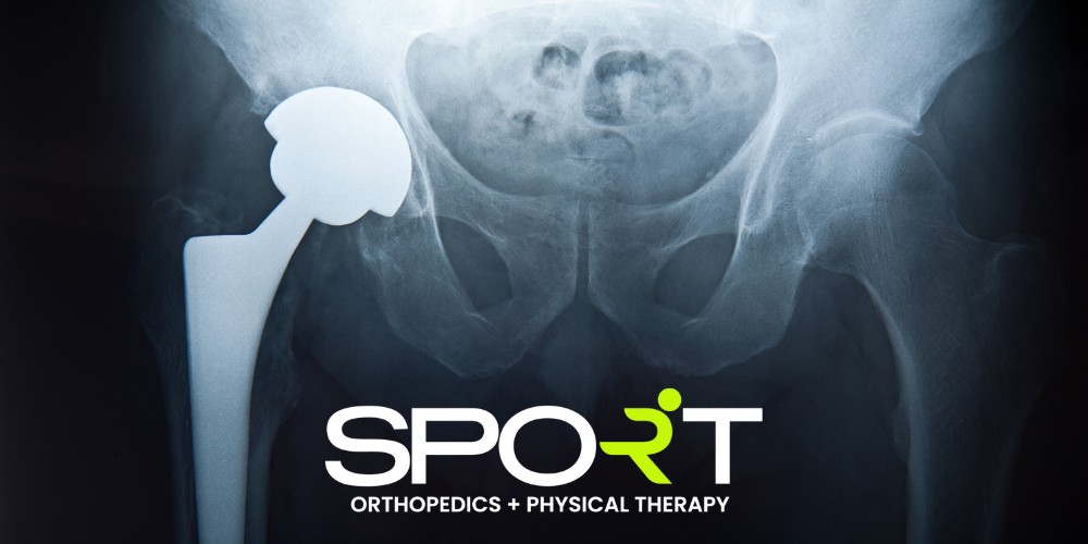 Hip Replacement Surgery in Dallas, TX